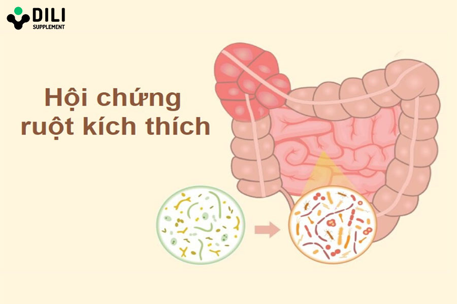 điều trị dứt điểm hội chứng ruột kích thích tại nhà