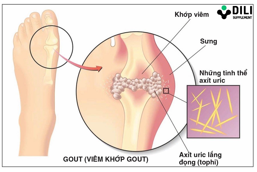 thực phẩm chức năng trị gout