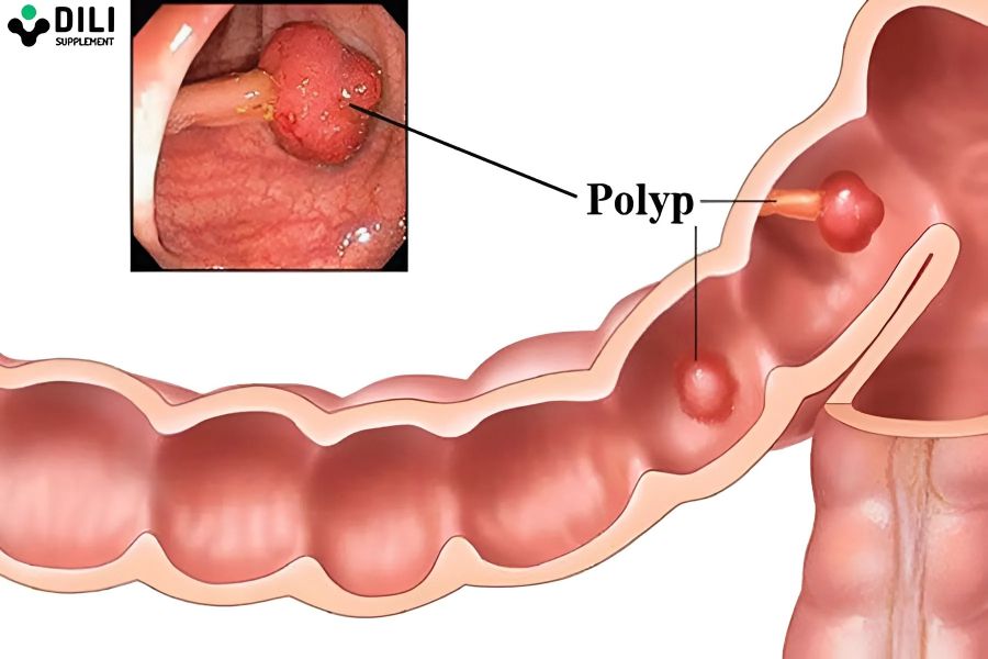 biến chứng của táo bón lâu ngày