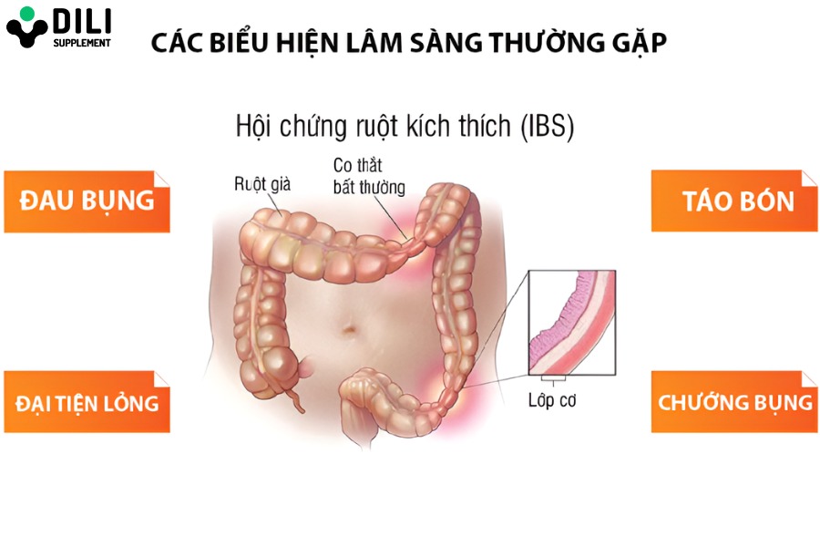 Biểu hiện hội chứng ruột kích thích
