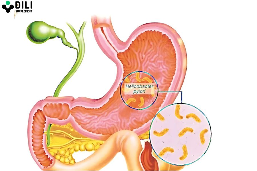 dấu hiệu viêm loét dạ dày nặng