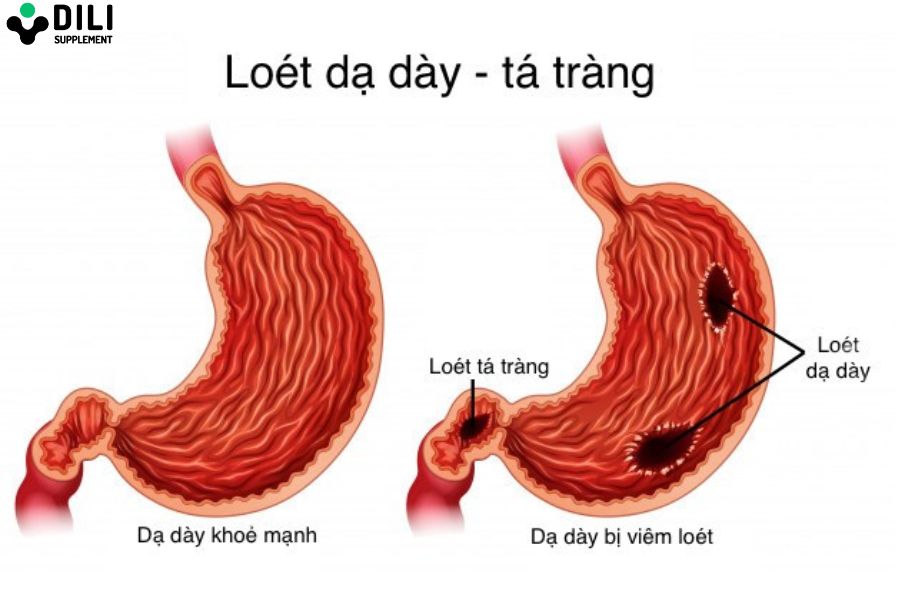 dấu hiệu viêm loét dạ dày nặng