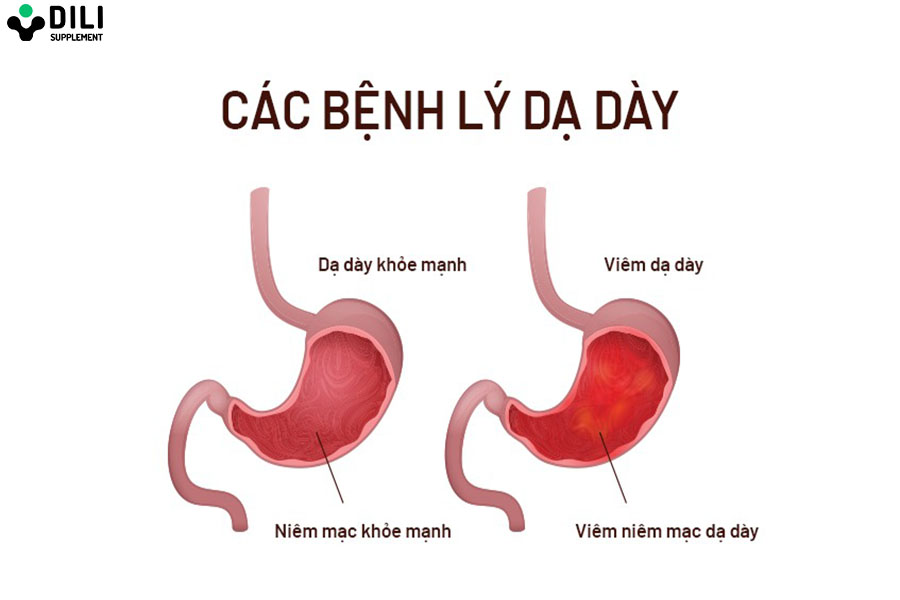 phân biệt viêm dạ dày và hội chứng ruột kích thích 1