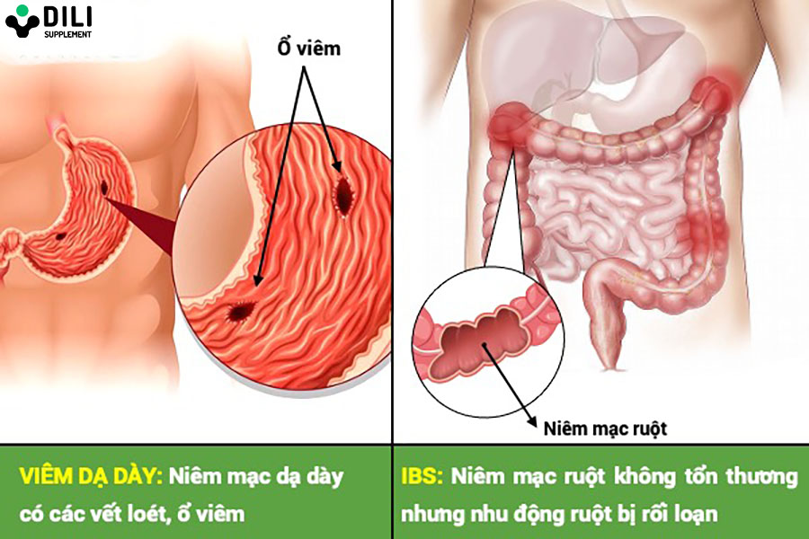 phân biệt viêm dạ dày và hội chứng ruột kích thích thế nào