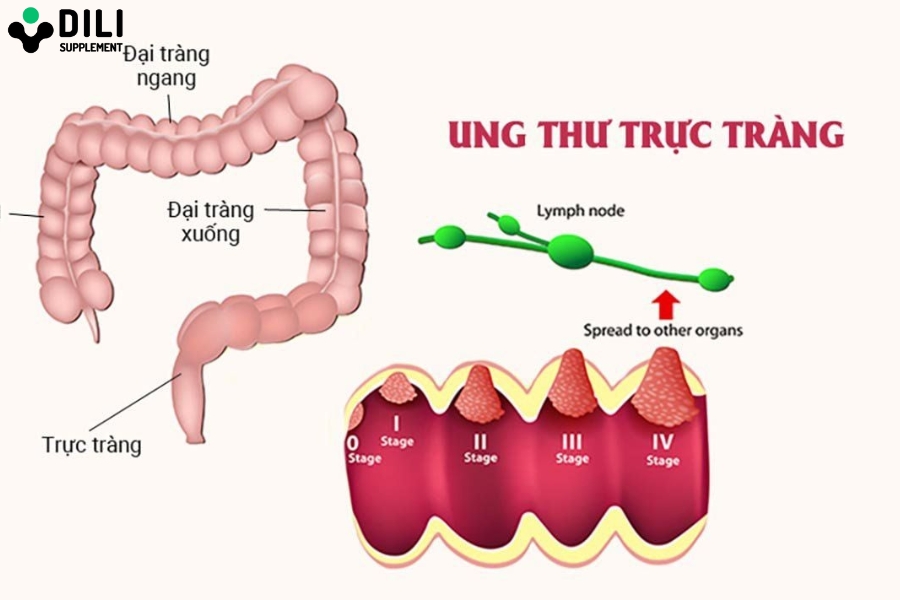 táo bón đi ngoài ra máu gây biến chứng gì