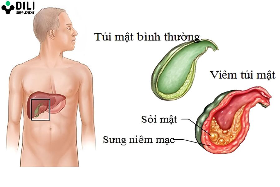 đau dạ dày ở vị trí nào đau túi mật