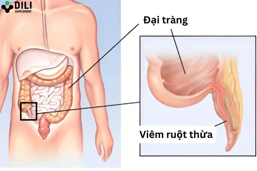 đau dạ dày ở vị trí nào viêm ruột thừa