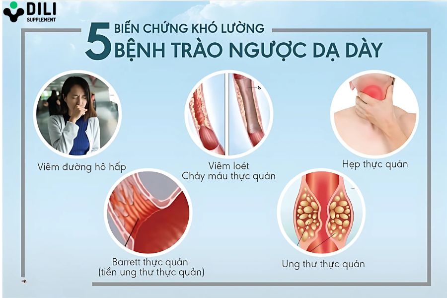 hp trào ngược dạ dày 5