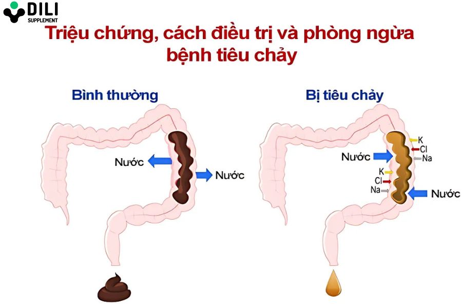 tiêu chảy cấp 3