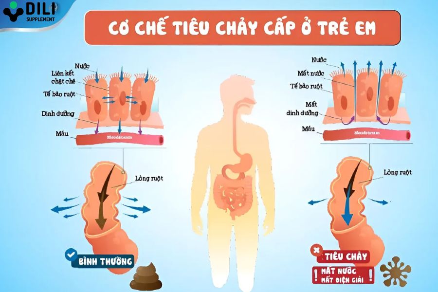 tiêu chảy cấp ở trẻ em 2
