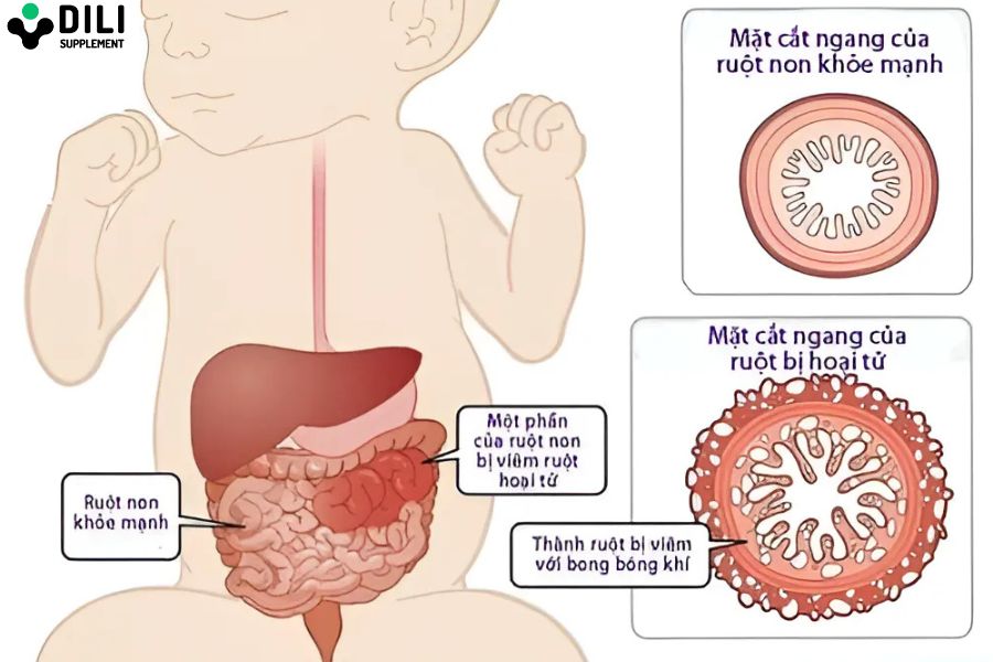 trẻ sơ sinh đi ngoài có bọt 5