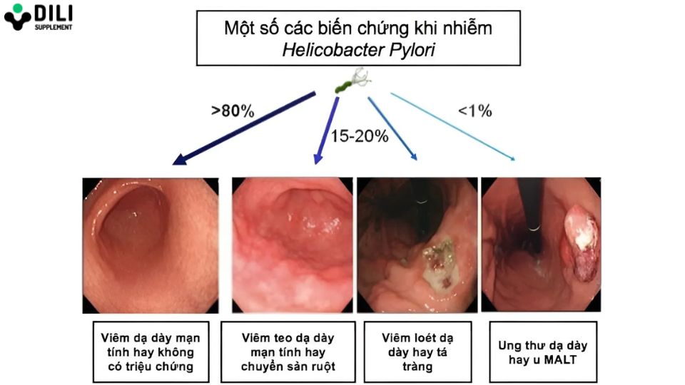 viêm dạ dày 3