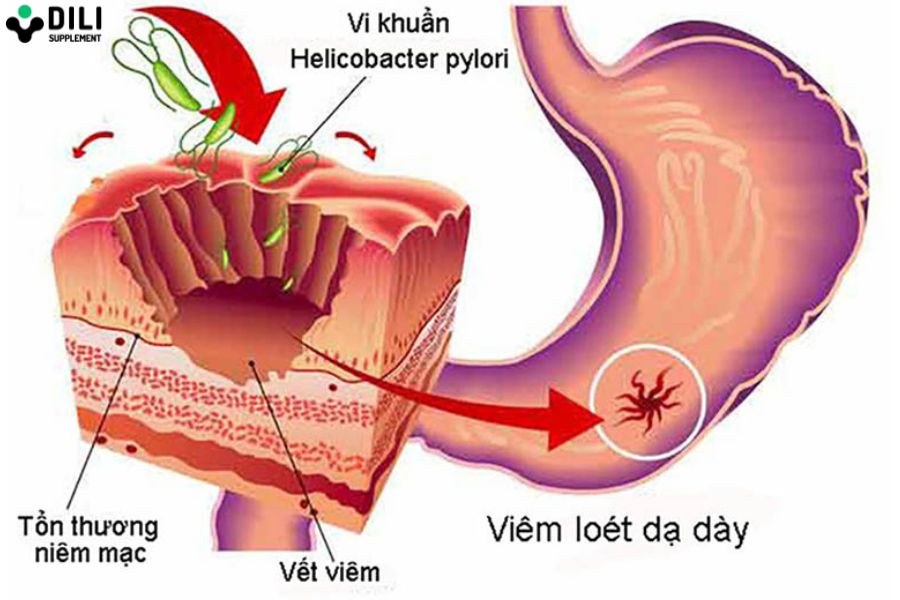 viêm dạ dày hp 1