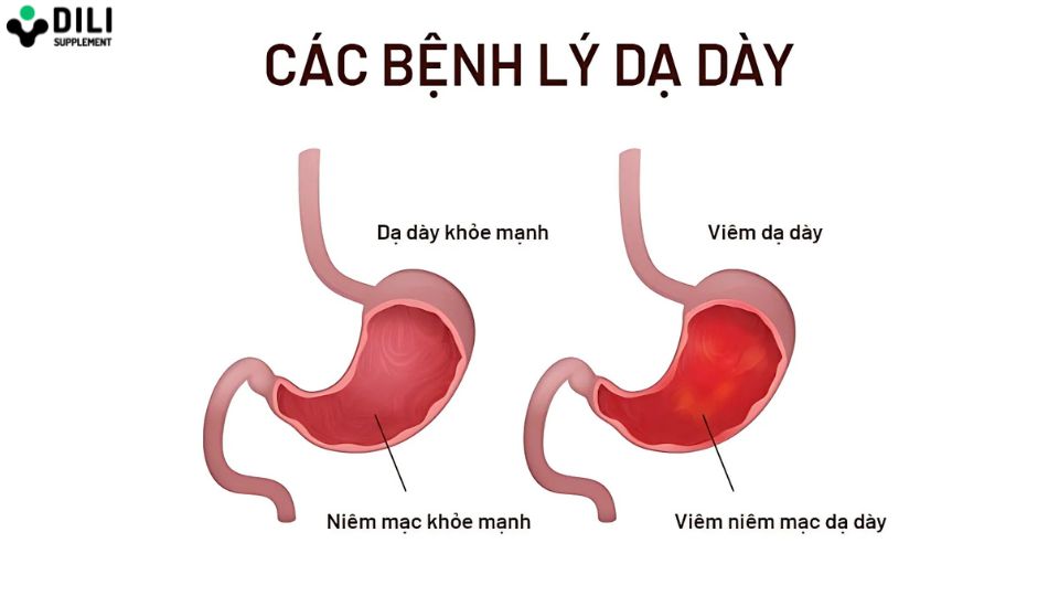 viêm dạ dày là gì