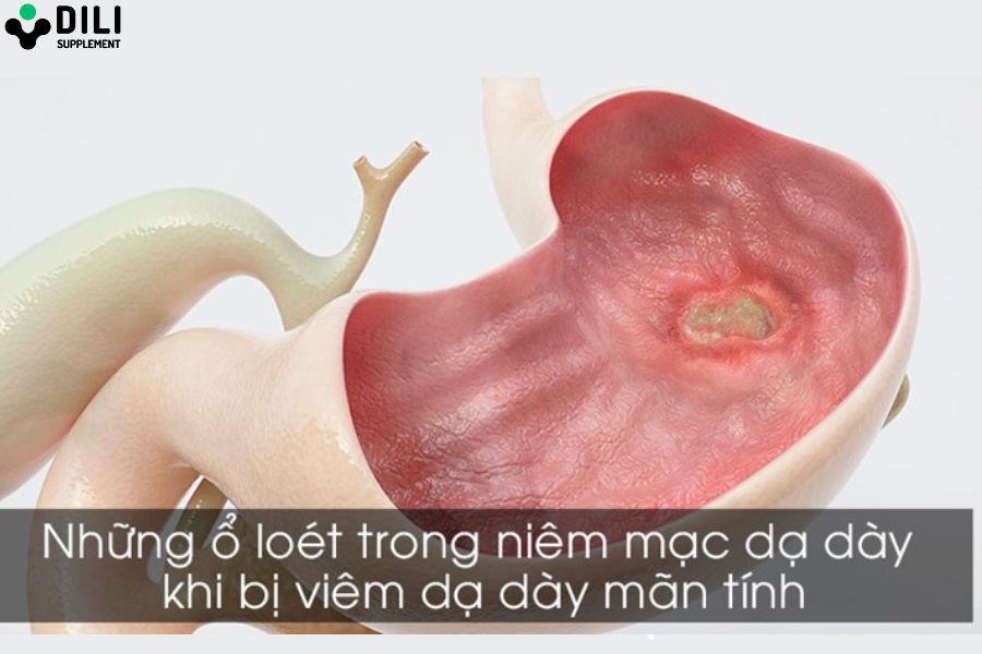 viêm dạ dày mạn tính