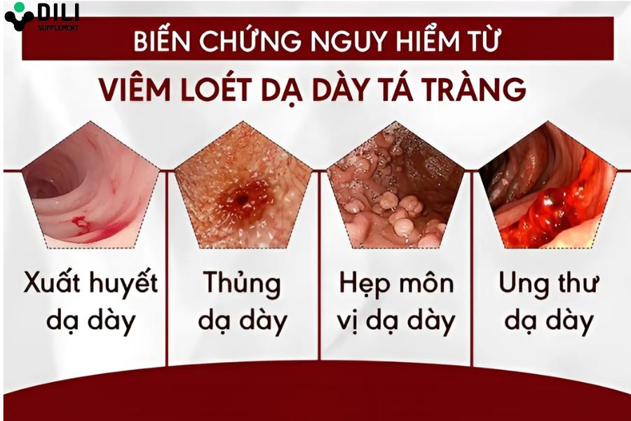 viêm loét dạ dày 1
