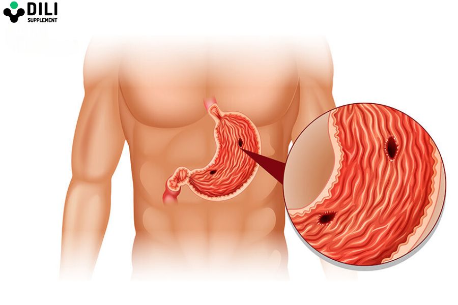 viêm loét dạ dày 3