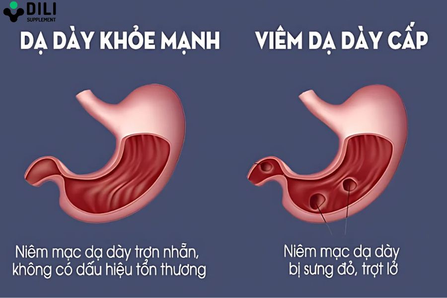 viêm loét dạ dày có mấy cấp độ 1