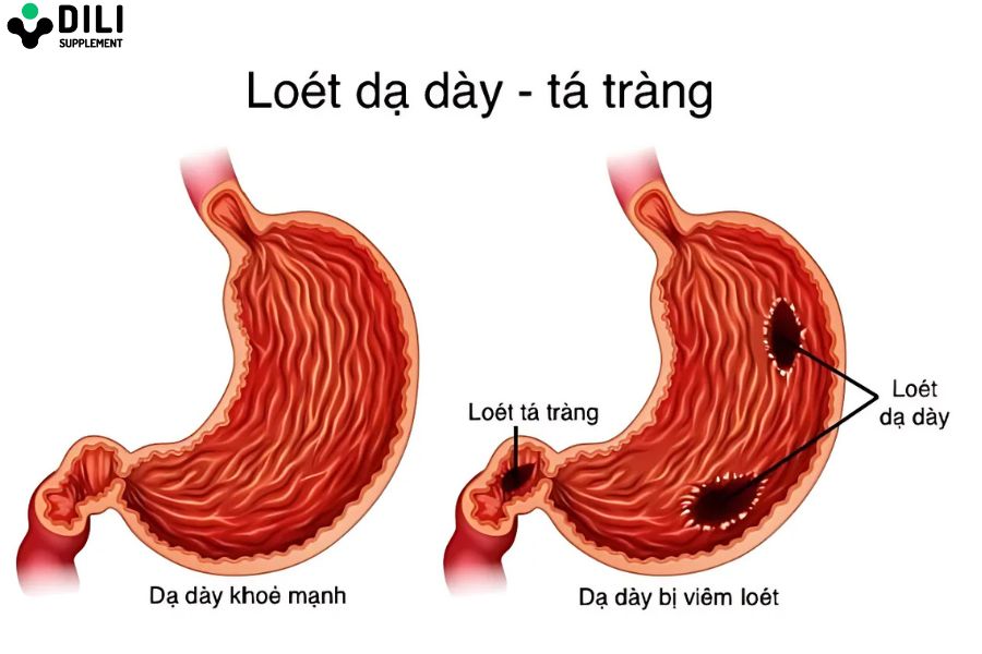 viêm loét dạ dày có mấy cấp độ 2