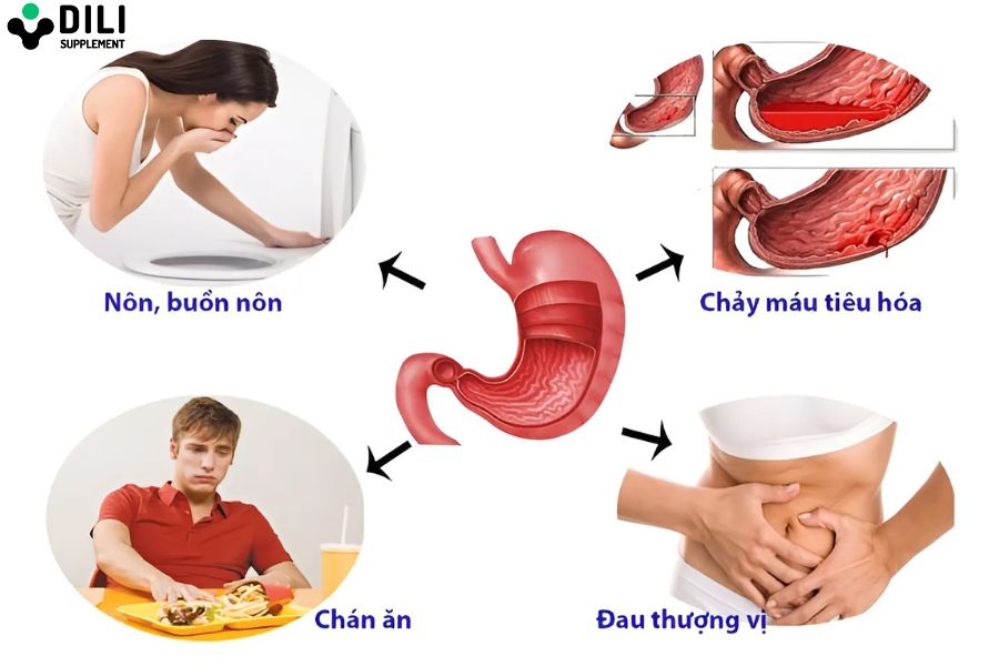 viêm loét dạ dày có mấy cấp độ 3