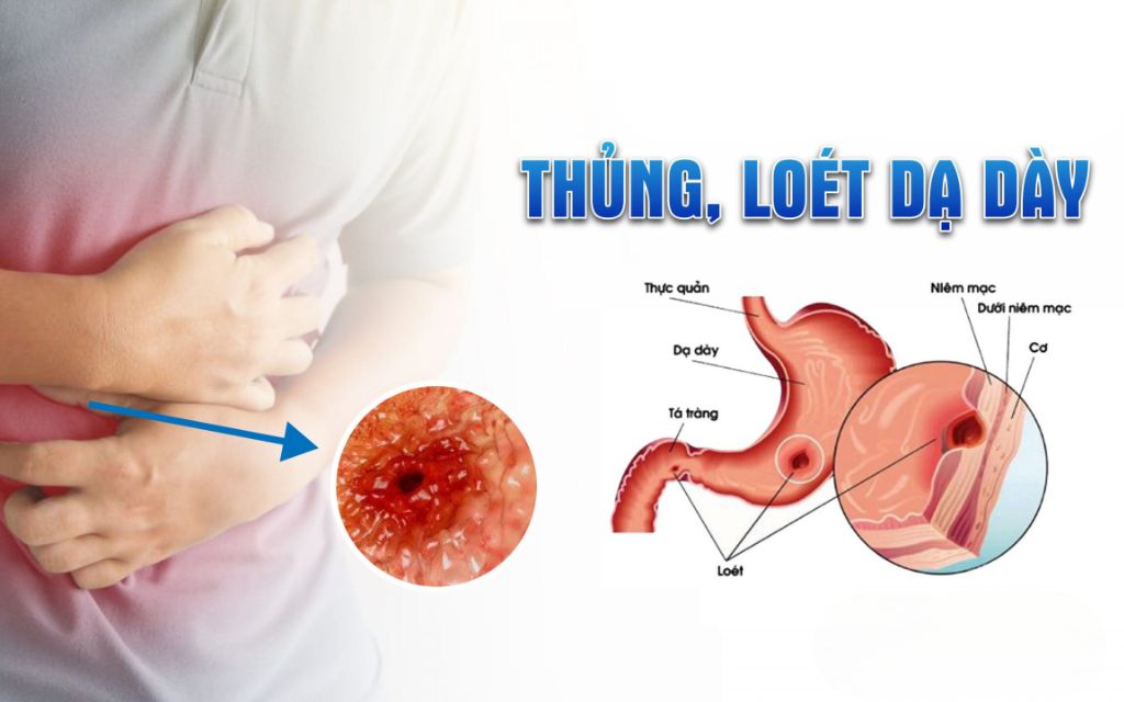 viêm loét dạ dày có mấy cấp độ 5