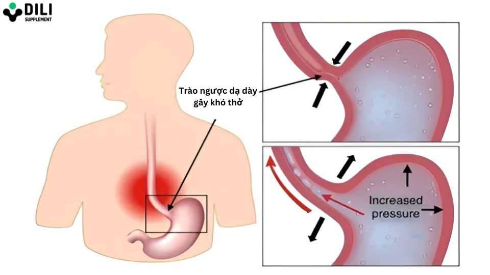 mẹo chữa trào ngược dạ dày khó thở 1