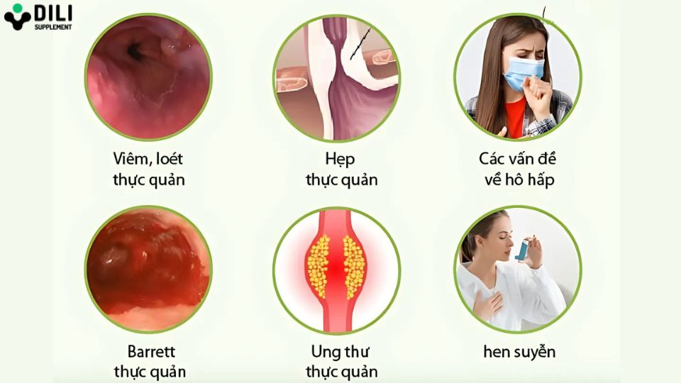 mẹo chữa trào ngược dạ dày khó thở 3