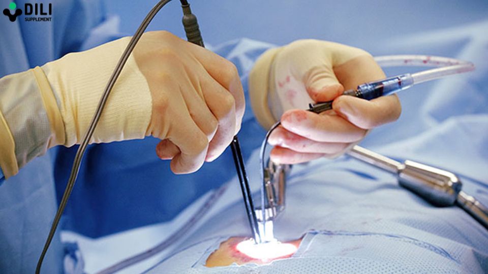 phẫu thuật trào ngược dạ dày thực quản