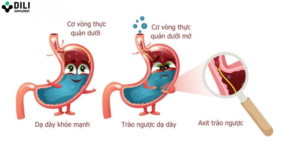 trào ngược dạ dày gây ho 1