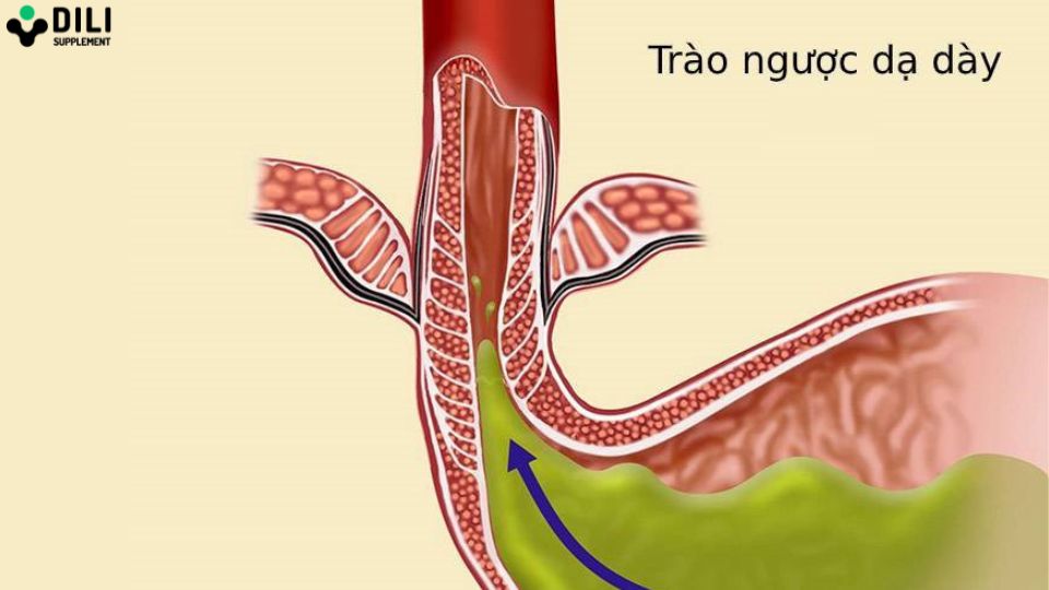 trào ngược dạ dày nghẹn cổ họng 1