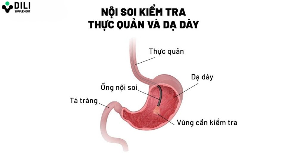 trào ngược dạ dày nghẹn cổ họng 2