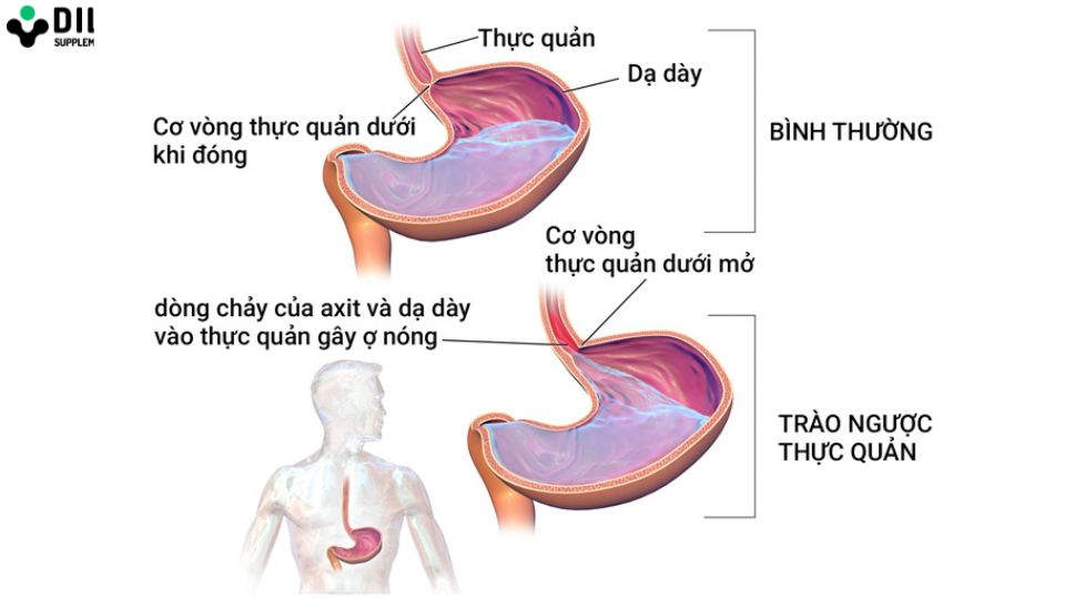 trào ngược dạ dày thực quản