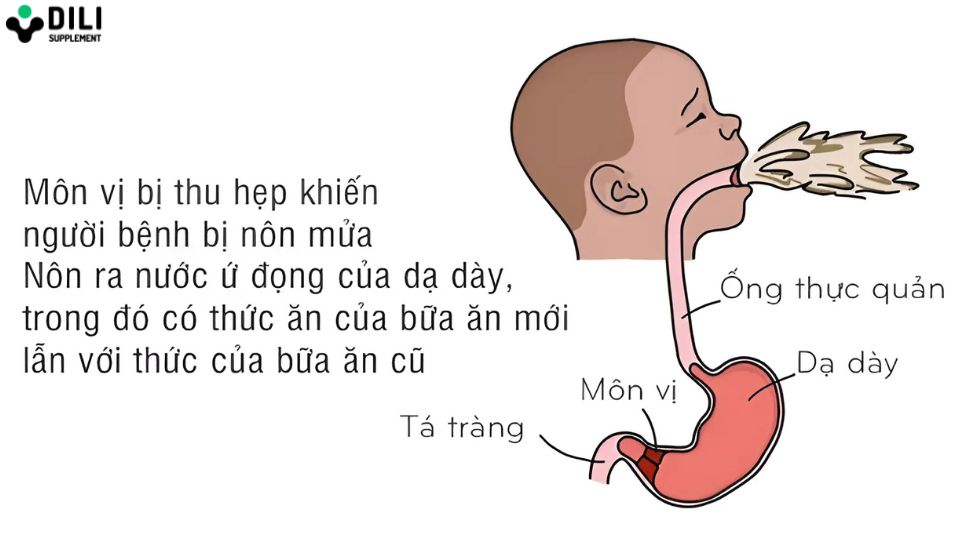 trẻ bị trào ngược dạ dày 2
