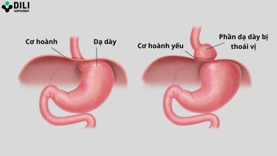nguyên nhân trẻ sơ sinh bị trào ngược dạ dày