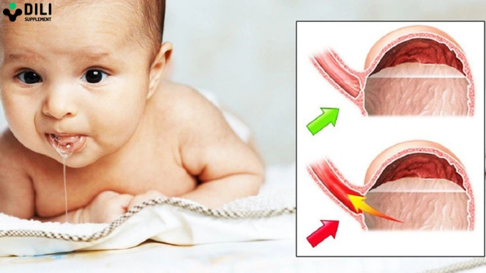 trẻ sơ sinh bị trào ngược dạ dày thực quản