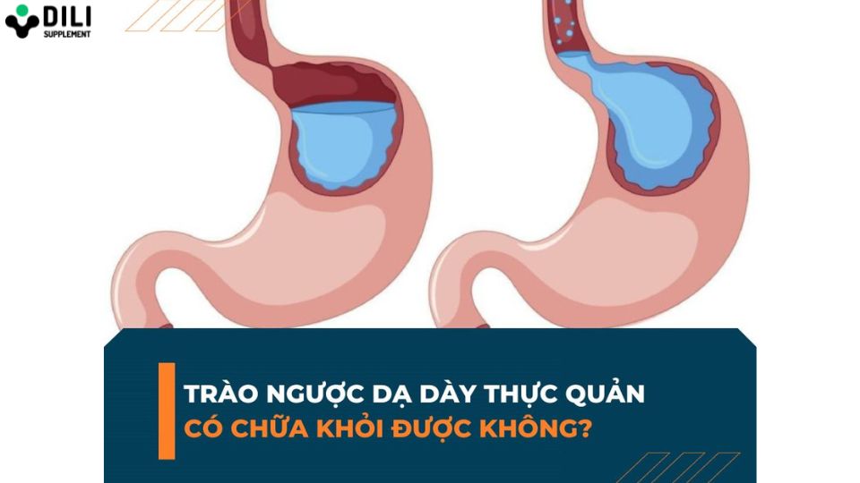 trị dứt điểm trào ngược dạ dày 2