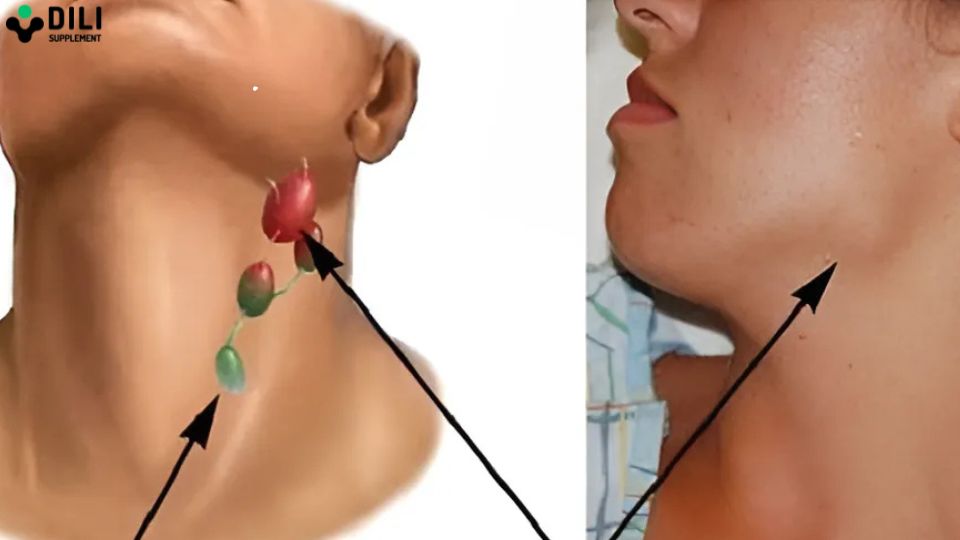 uống bia nhiều bị gì ung thư vòm họng.