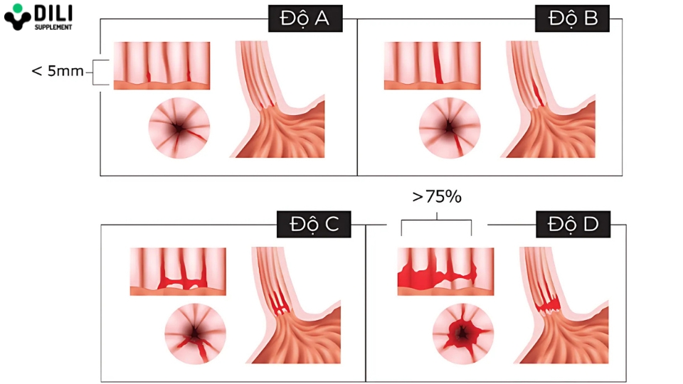 trào ngược dạ dày thực quản độ a 1