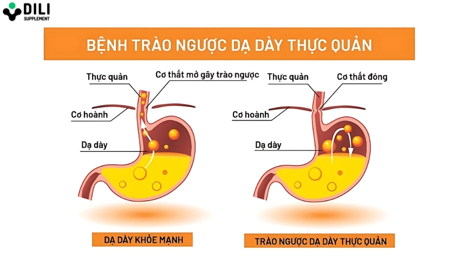 trào ngược dạ dày thực quản độ a là gì