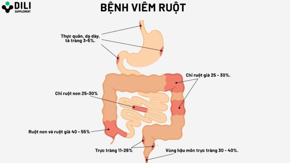 tiêu chảy kéo dài do viêm ruột